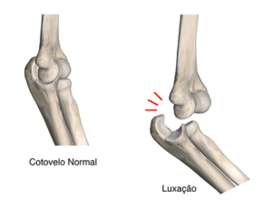 Luxação do cotovelo 