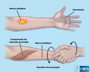 Síndrome do pronador