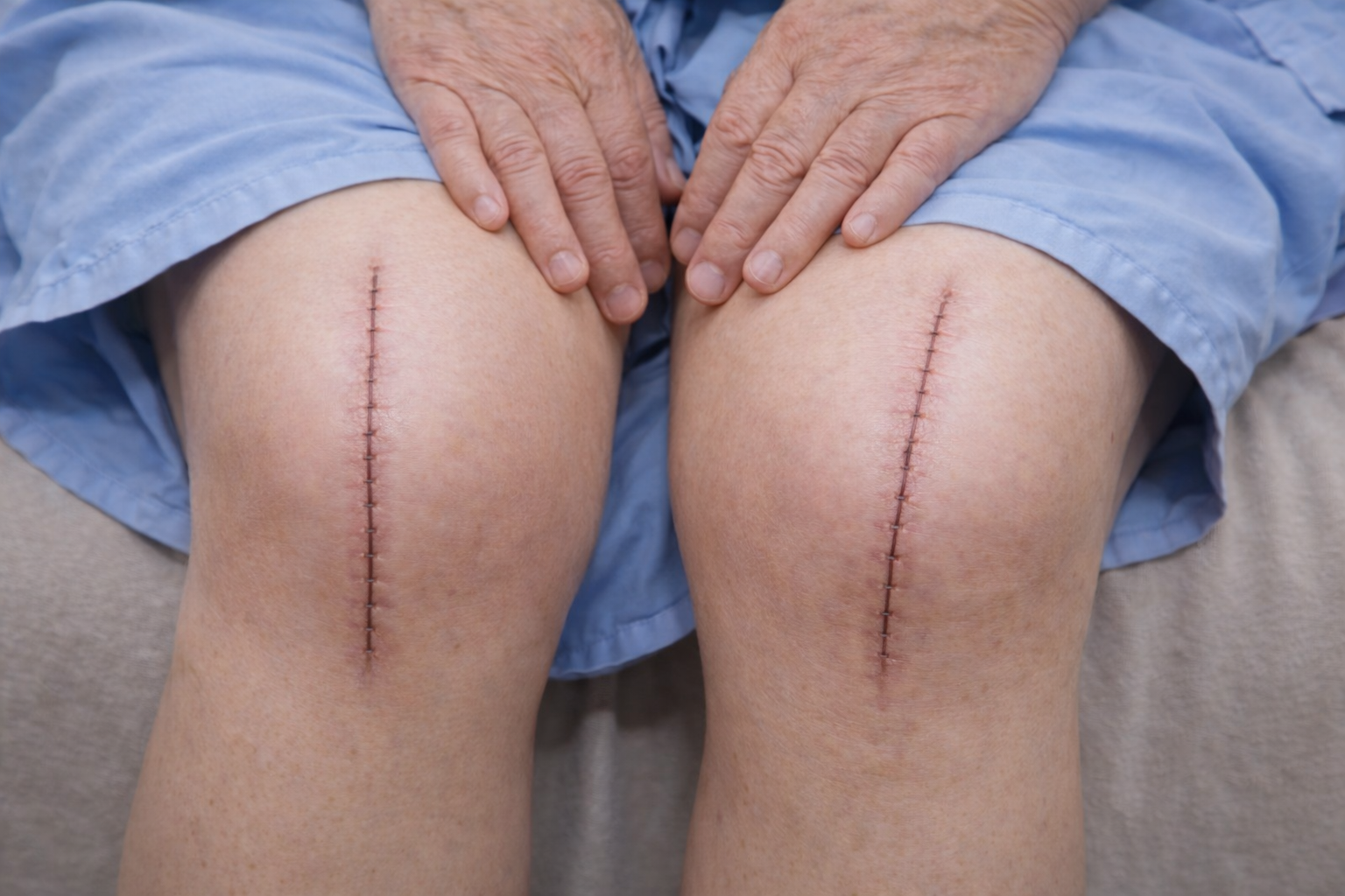 Prótese de joelho: quando caminhar no pós-operatório